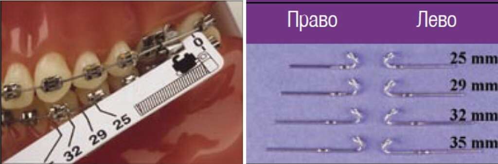 Установка аппарату Forsus™ EZ